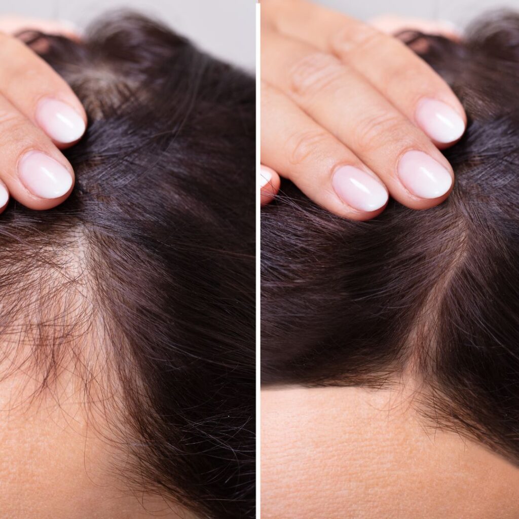 biotin hair loss