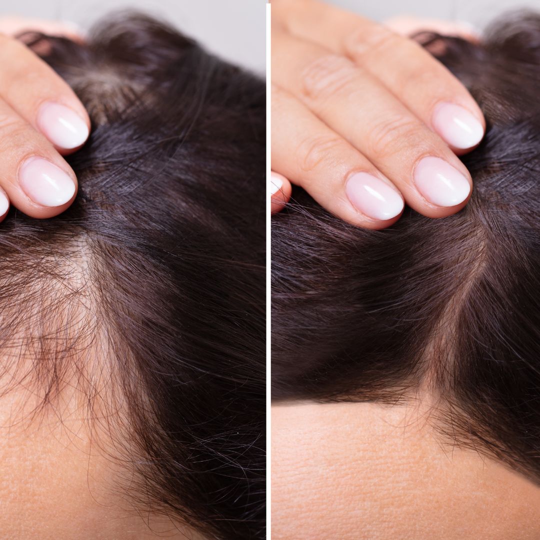 biotin hair loss